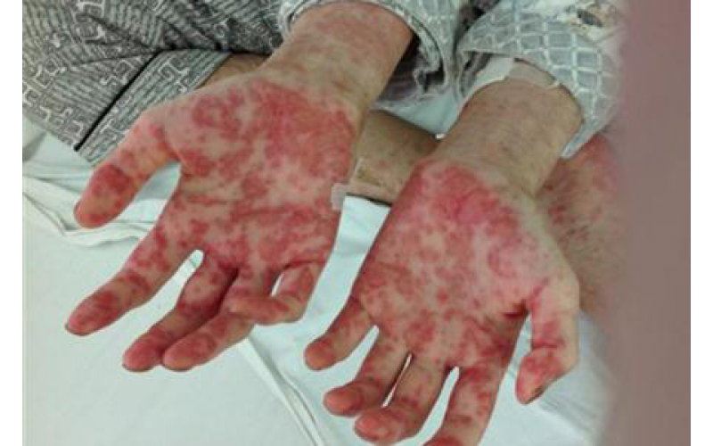 白血病重磅！首款IDH1抑制剂Tibsovo获美国FDA批准，基石药业豪掷30亿元引进中国